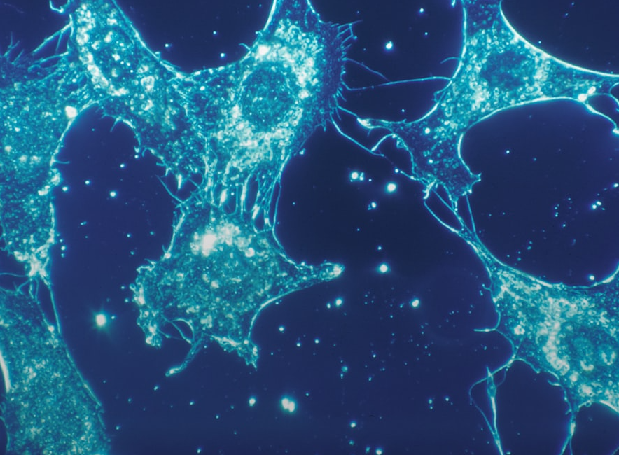 le montélukast, médicament contre l’asthme, pourrait révolutionner le traitement des cancers agressifs
