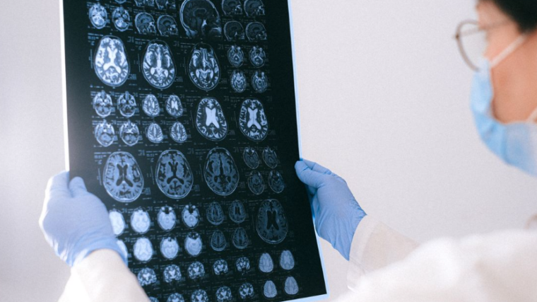 Implant cérébral et IA : une avancée majeure contre la maladie de Charcot