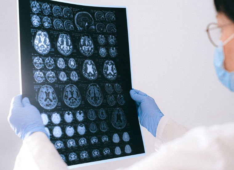 Implant cérébral et IA : une avancée majeure contre la maladie de Charcot
