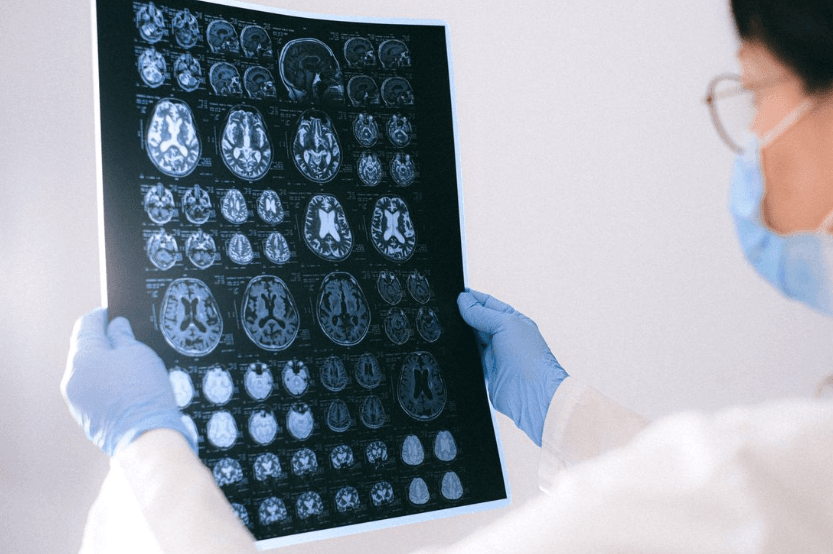 Implant cérébral et IA : une avancée majeure contre la maladie de Charcot