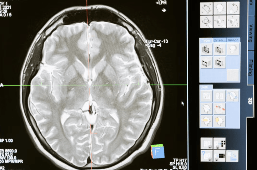 Une avancée prometteuse contre les protéines toxiques liées à Alzheimer