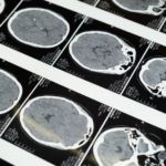 Des chercheurs japonais ont identifié un possible déclencheur de la maladie d’Alzheimer