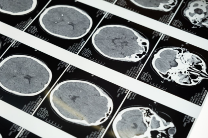Des chercheurs japonais ont identifié un possible déclencheur de la maladie d’Alzheimer