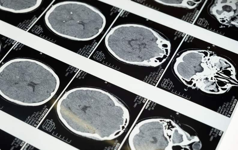 Des chercheurs japonais ont identifié un possible déclencheur de la maladie d’Alzheimer