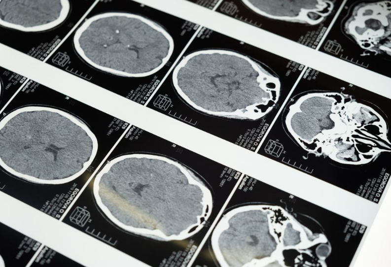Des chercheurs japonais ont identifié un possible déclencheur de la maladie d’Alzheimer