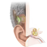 L’Autriche dévoile le premier implant cochléaire totalement invisible.