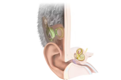 L’Autriche dévoile le premier implant cochléaire totalement invisible.