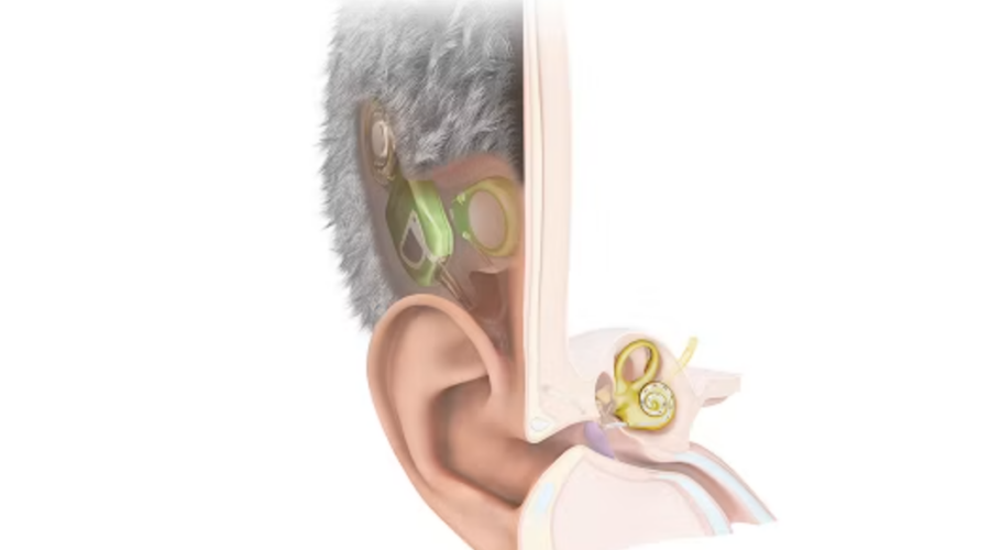 L’Autriche dévoile le premier implant cochléaire totalement invisible.
