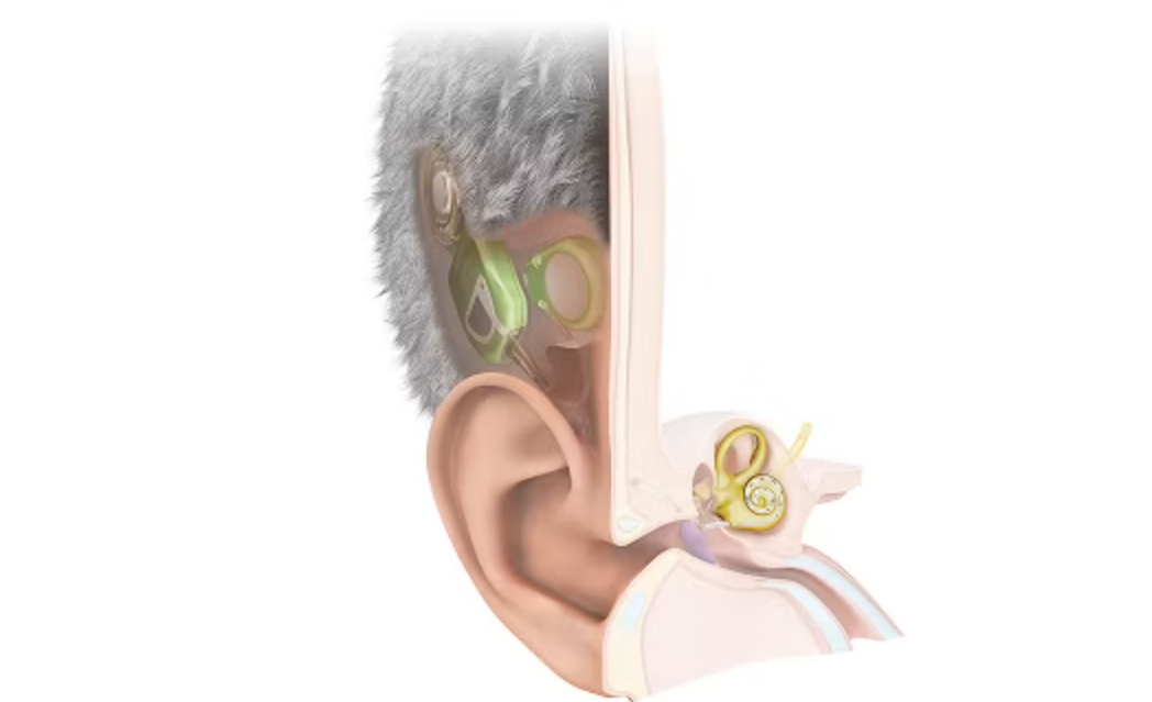 L’Autriche dévoile le premier implant cochléaire totalement invisible.